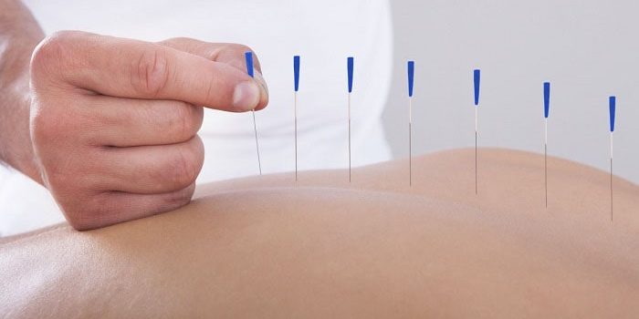 مراحل و مزایای طب سوزنی برای رفع دردهای اسکلتی عضلانی