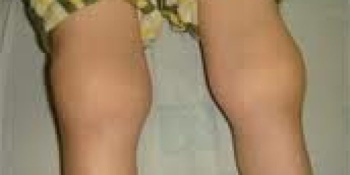 مفاصل کوکان