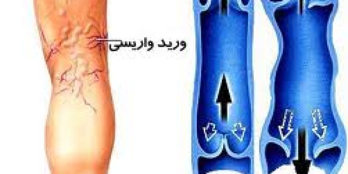 واریس