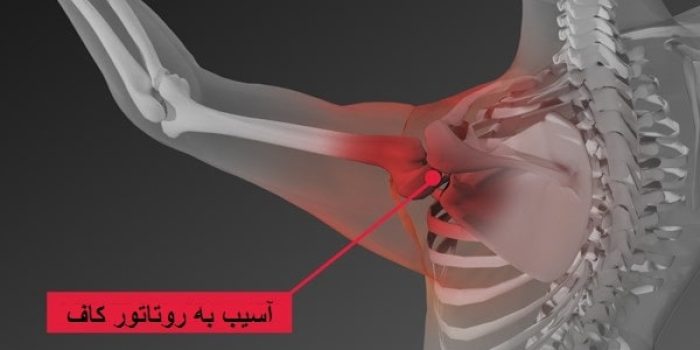 پارگی روتاتور کاف شانه(عدم اتصال تاندونهای چهار عضله)بایا بدون جراحی