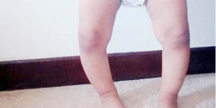 پاهای-پرانتزی