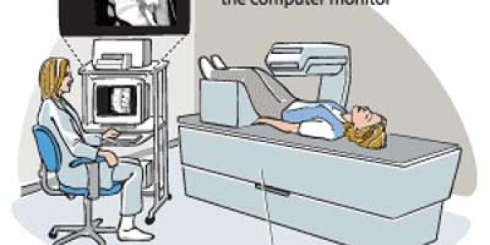 پوکی استخوان+تشخیص+1