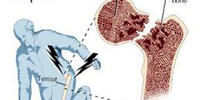 پوکی استخوان+شکستگی