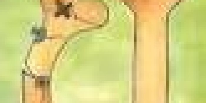 پوکی استخوان2