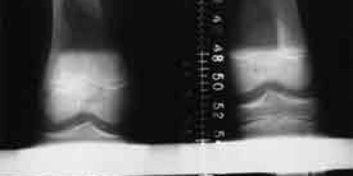 کوتاه شدن اندام