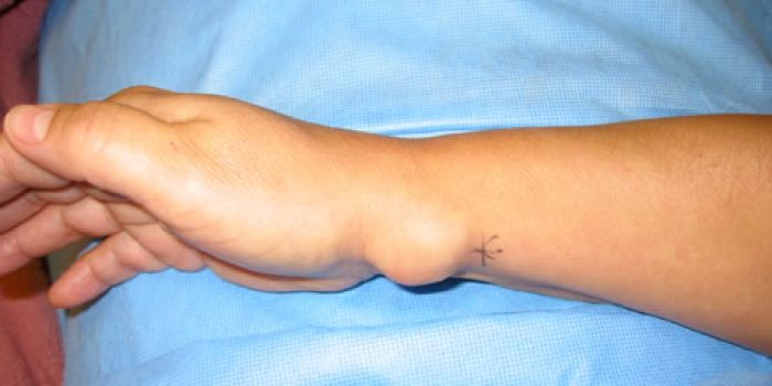 کیست استخوان